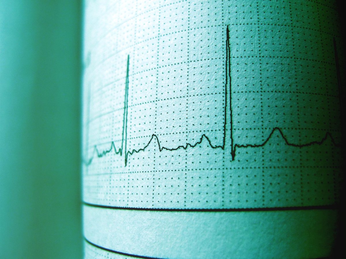 Fréquence cardiaque au repos : normes, interprétation et amélioration